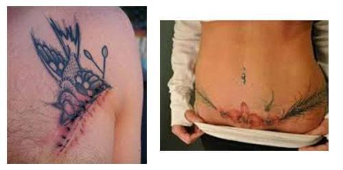 Tatuaje para tapar cicatriz abdominoplastia