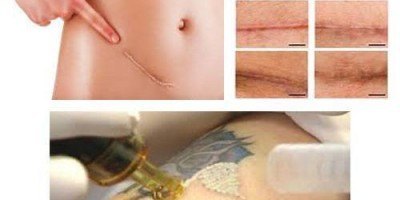 Tatuajes para abdominoplastia