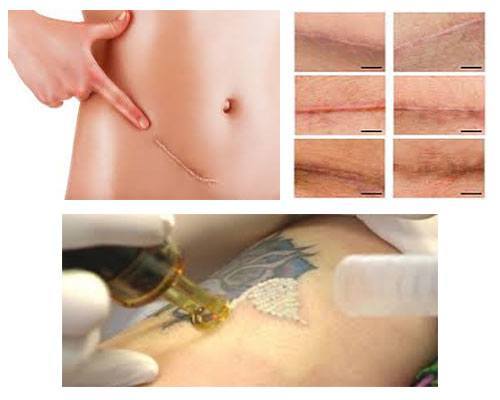 Tatuajes para abdominoplastia